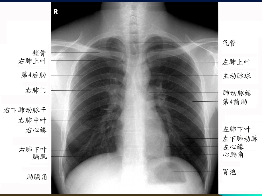 胸部X线影像解剖.ppt_第3页