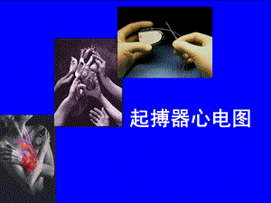 起搏器心电图的解读.ppt