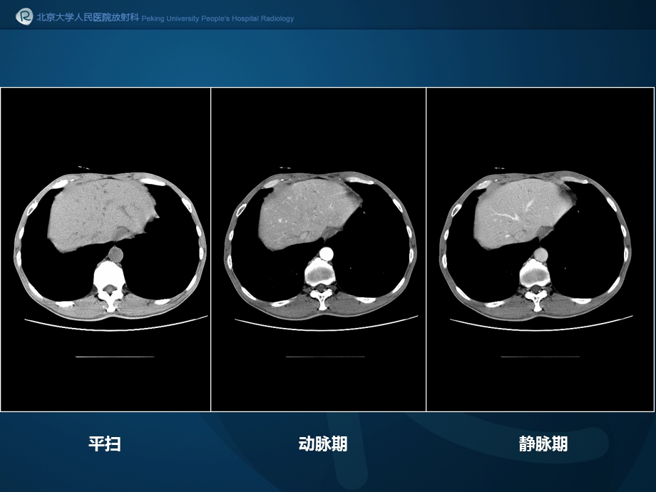 igg相关性胰腺炎ppt课件.ppt_第3页