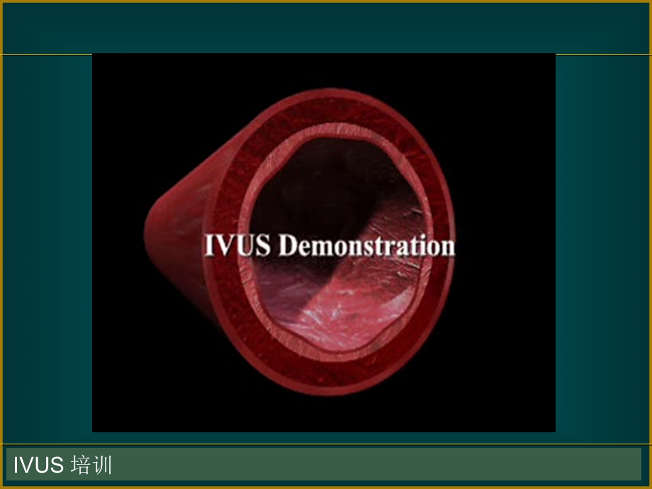 IVUS-血管内超声基础和临床.ppt_第2页