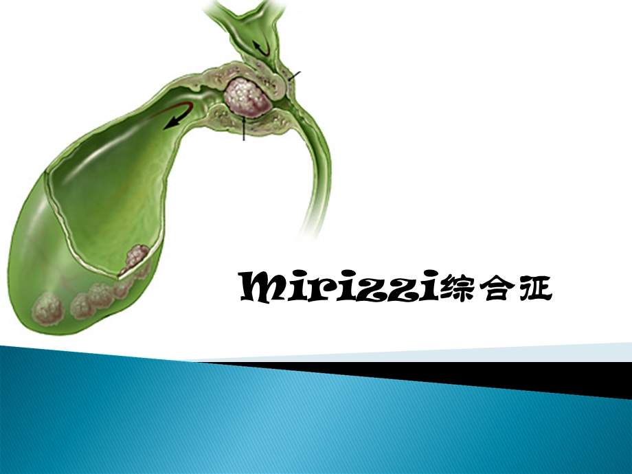 mirrizi综合征.ppt_第1页