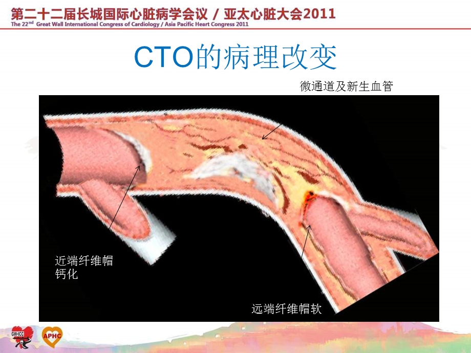 CTO病变的逆向法.ppt_第2页