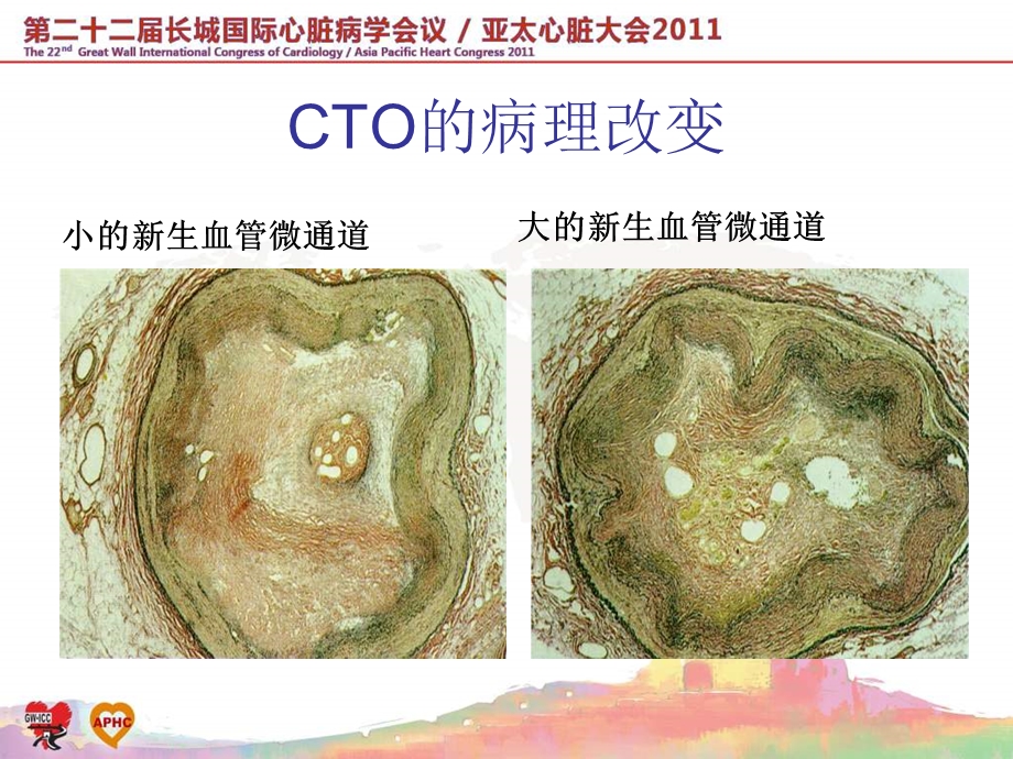 CTO病变的逆向法.ppt_第3页