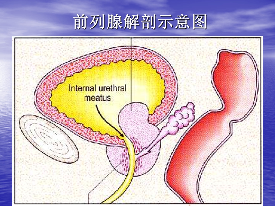 TURP并发症及其防治.ppt_第2页