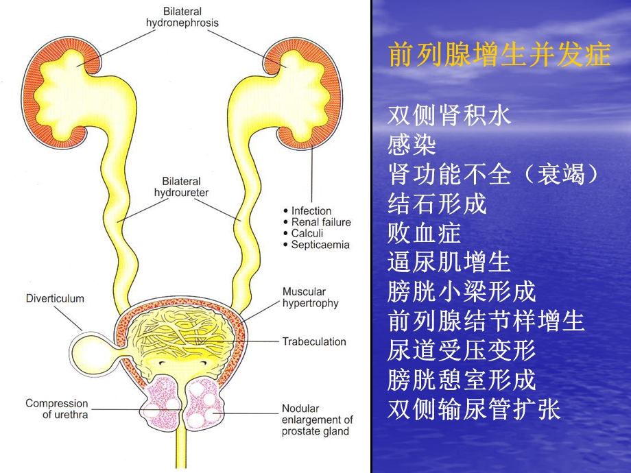 TURP并发症及其防治.ppt_第3页