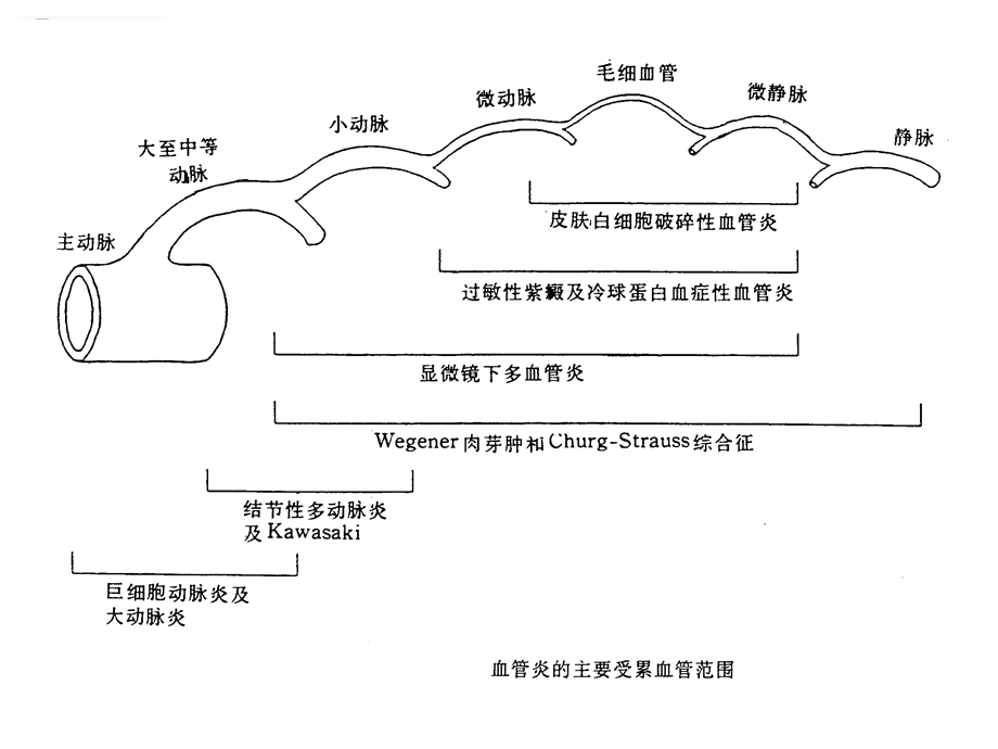 ANCA相关性血管炎的诊治进展.ppt_第3页