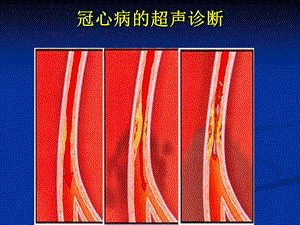 56冠心病的超声诊断.ppt