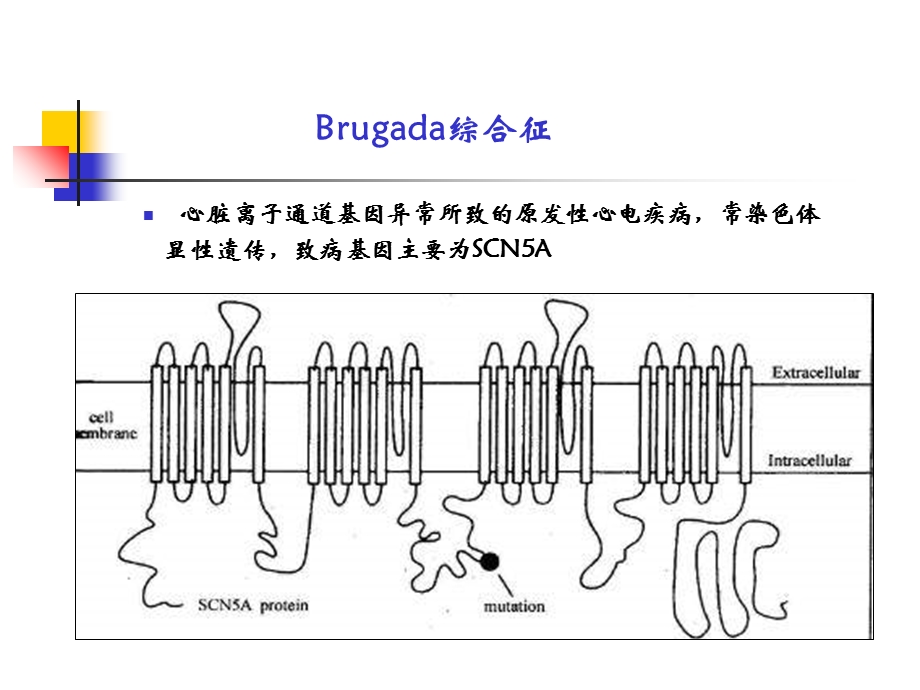 Brugada综合征及临床对策.ppt_第3页