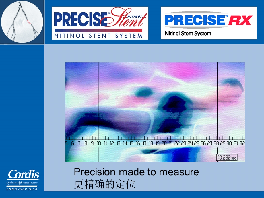 Cordis颈动脉狭窄介入治疗整体解决方案.ppt_第2页