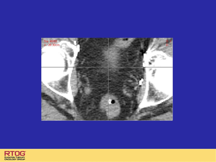 RTOG前列腺癌术后靶区勾画.ppt_第3页