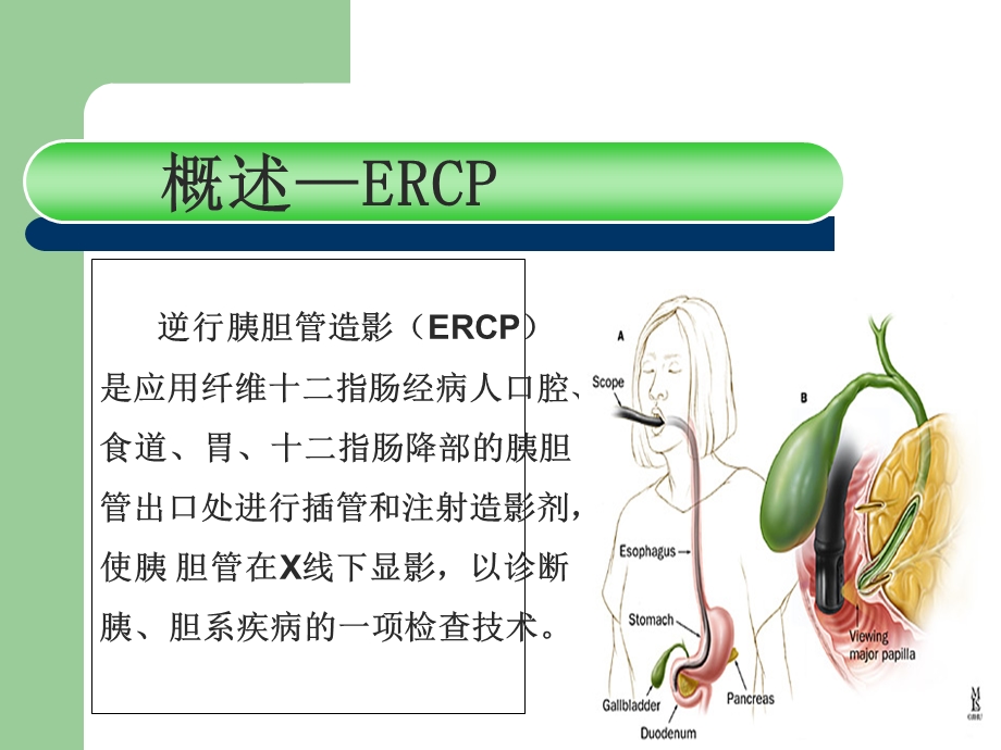 ERCP及术前术后护理.ppt_第3页