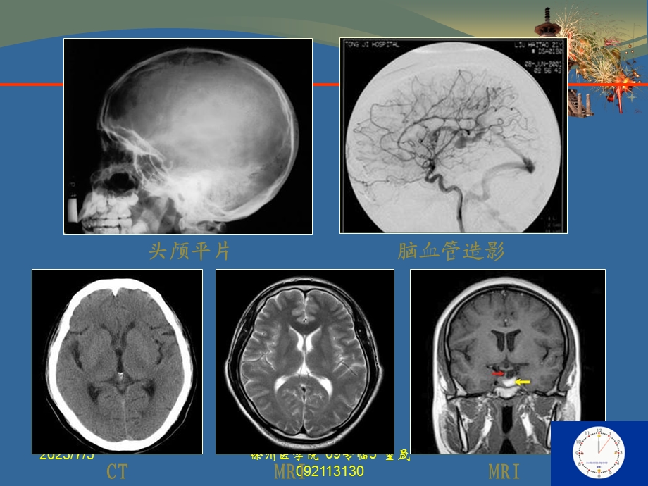 ctmri颅脑影像看.ppt_第3页