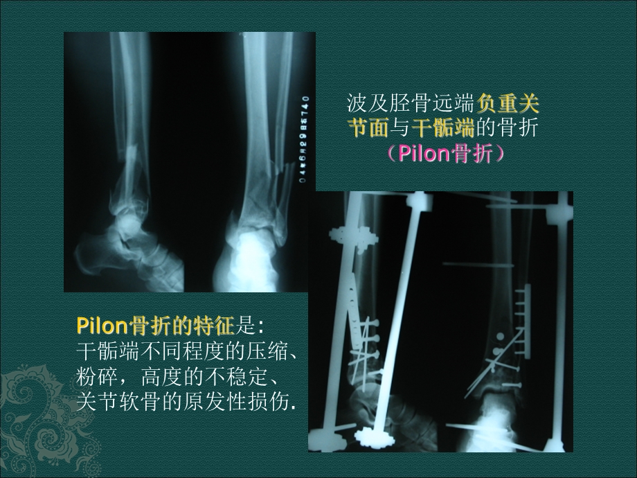 Pilon骨折课件.ppt_第3页