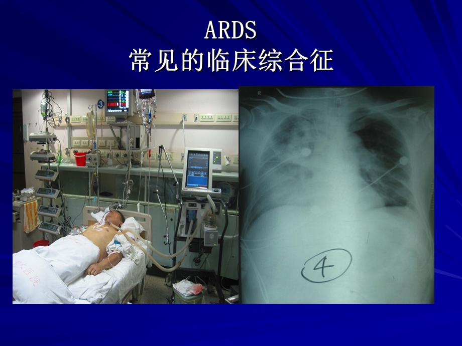 ARDS的治疗策略.ppt_第3页