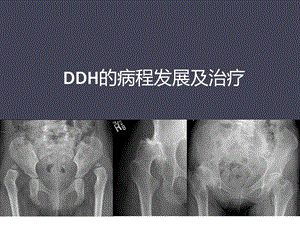 DDH的病程发展及治疗.ppt