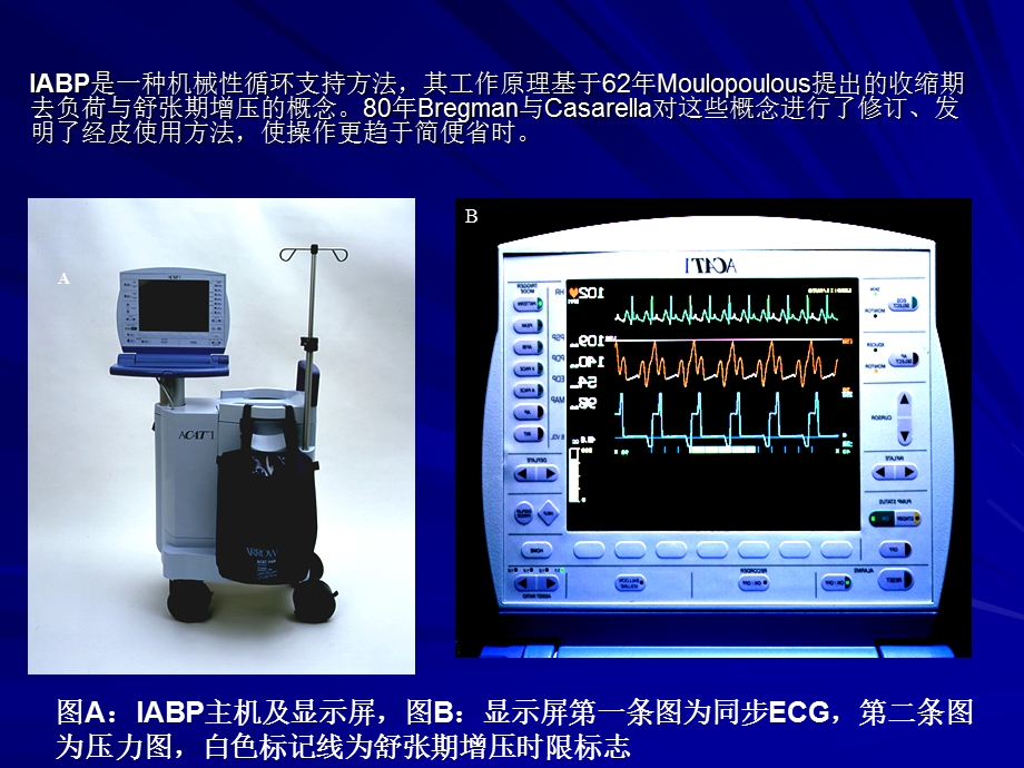 IABP-安贞医院.ppt_第2页