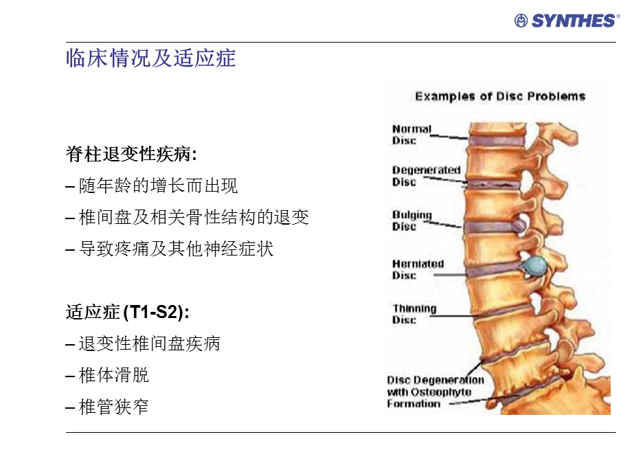 angea上开口多轴向椎弓根螺钉产品介绍.ppt_第3页