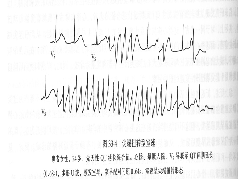 QT间期延长综合征.ppt_第3页