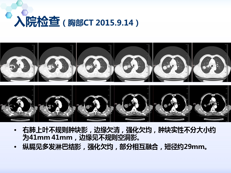 王慧娟肺鳞癌免疫治疗进展.ppt_第3页