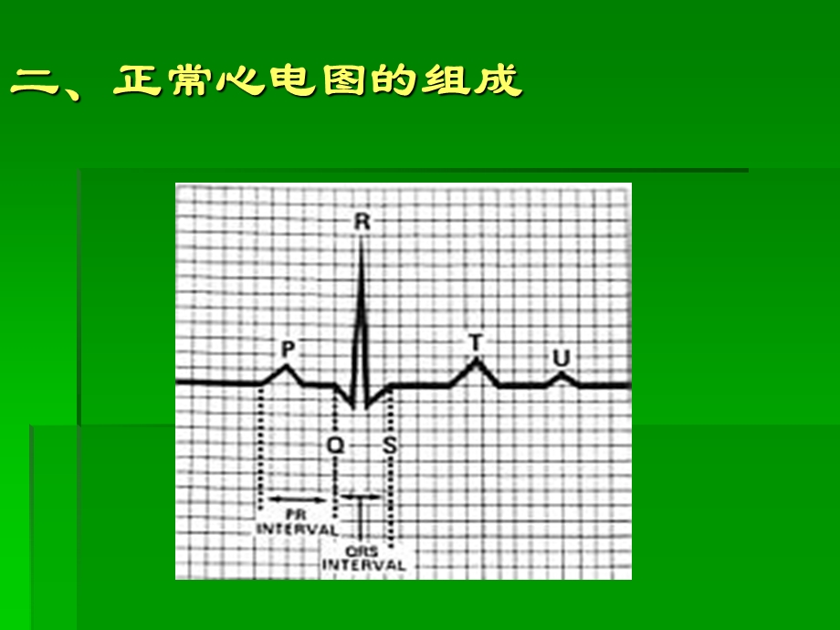 icu常见心电图知识.ppt_第3页