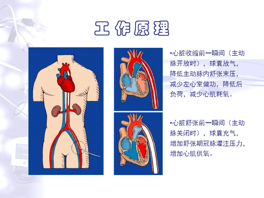 IABP(主动脉内球囊反搏泵)置管术.ppt_第3页