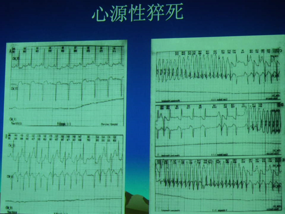 ICD临床应用进展.ppt_第3页