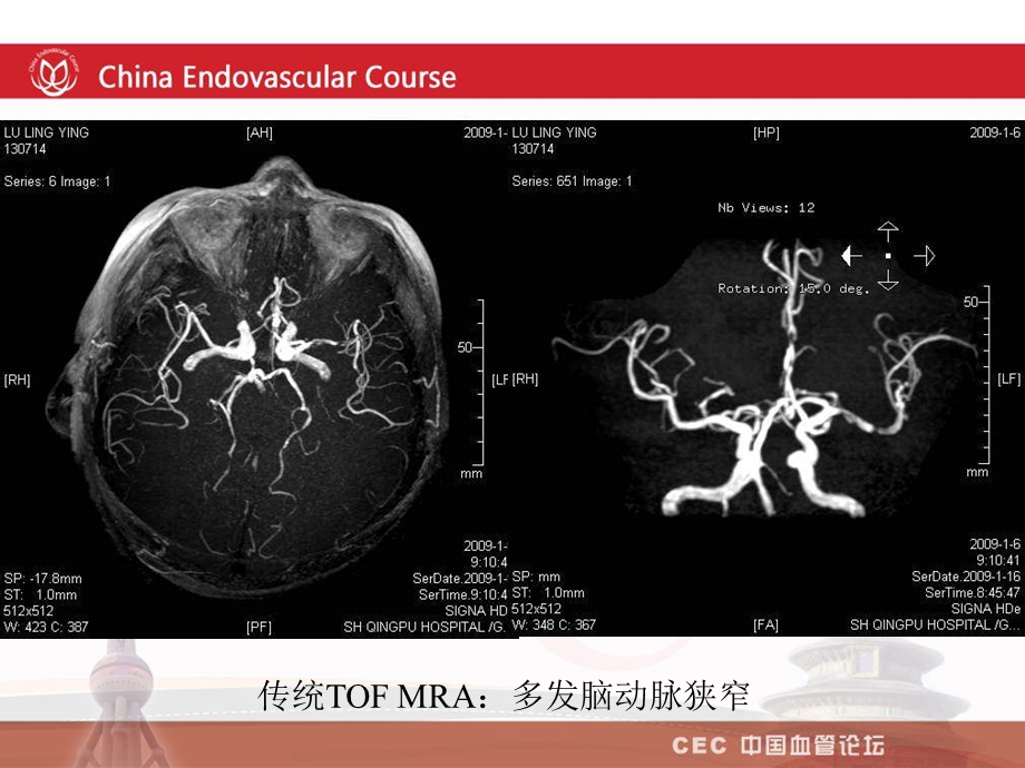 mra在血管疾病诊断中的应用.ppt_第3页