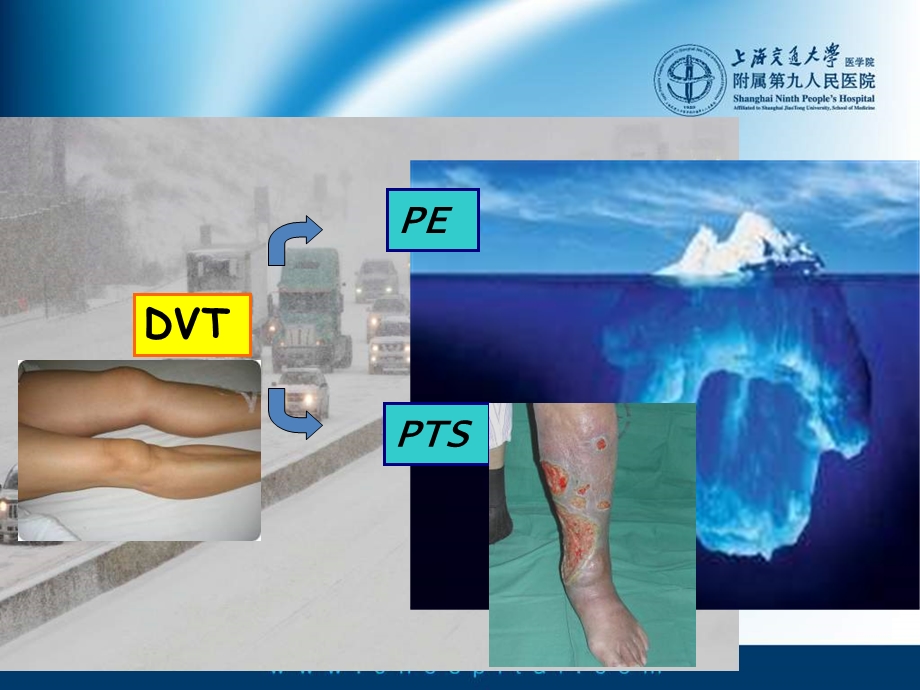 PTS的腔内治疗适应症和开通技巧.ppt_第2页