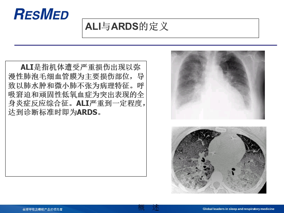 ARDS与机械通气.ppt_第3页