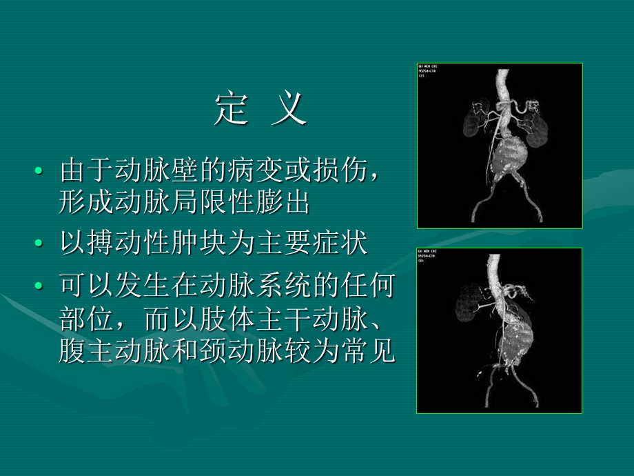 《动脉瘤CT表现》PPT课件.ppt_第2页