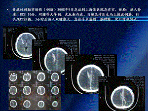 中国颅脑创伤救治指南解读.ppt