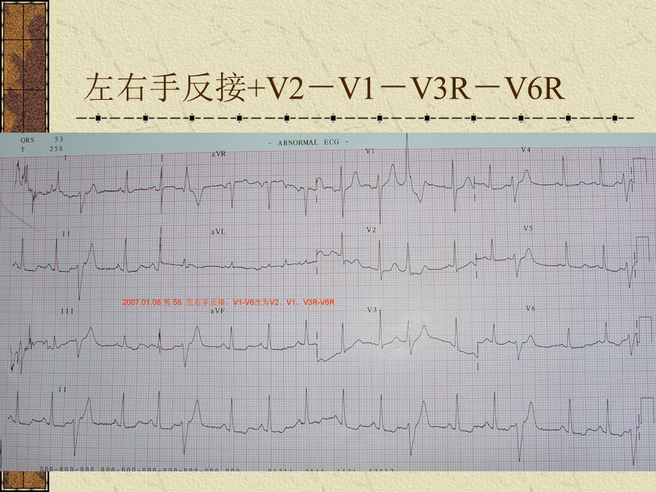 《心电图正常值》PPT课件.ppt_第3页