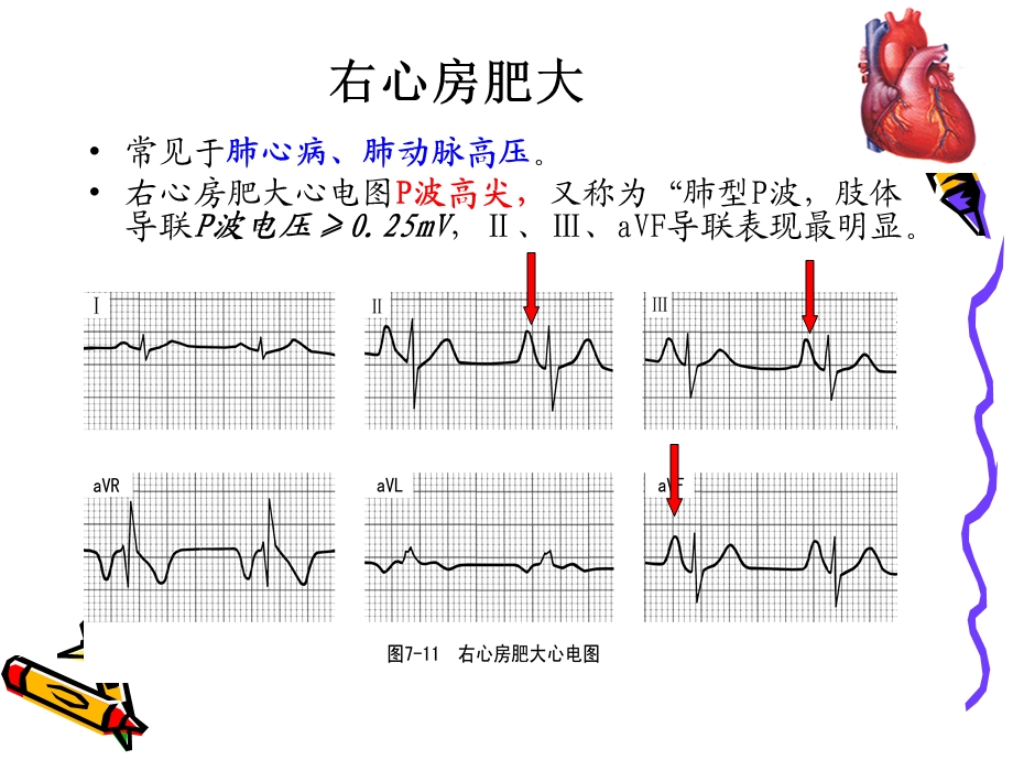 《常见异常心电图》PPT课件.ppt_第3页