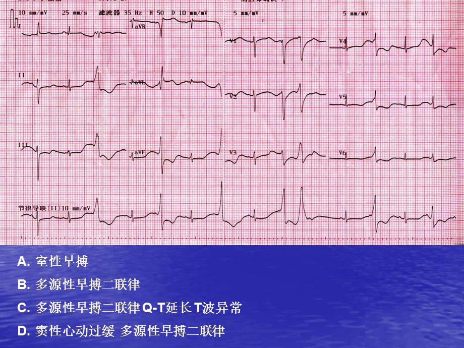 心电图考试练习.ppt_第3页