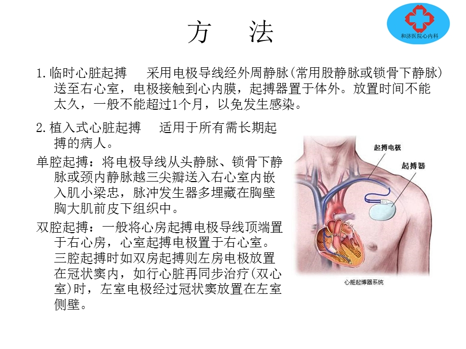 《心脏起搏治疗》PPT课件.ppt_第2页