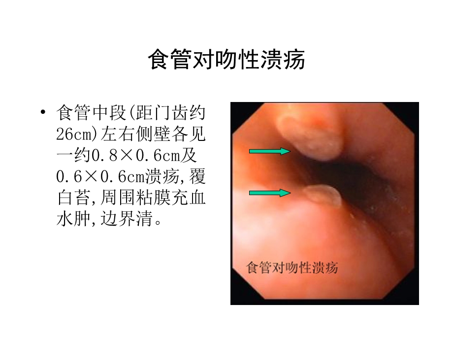 《典型内镜图片》PPT课件.ppt_第1页