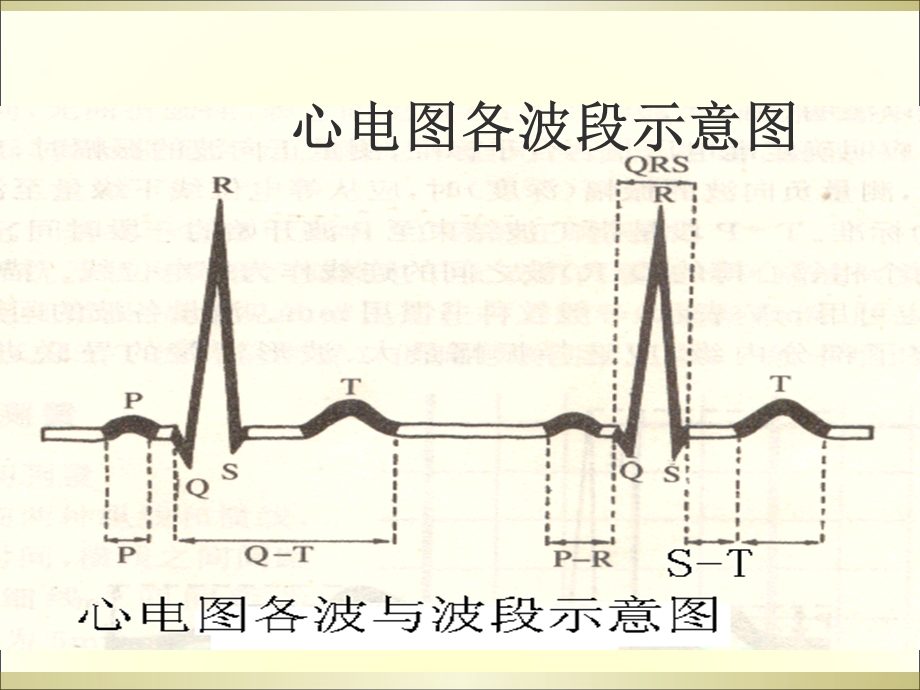 《常见心电图分析》PPT课件.ppt_第2页