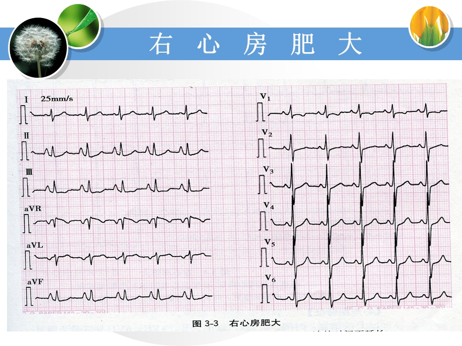 右心房肥大.ppt_第3页