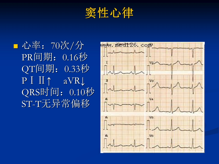 《心电图表现》PPT课件.ppt_第3页