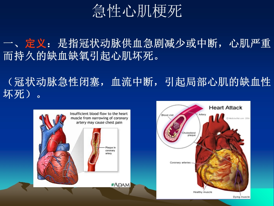 《急性心肌梗死》PPT课件.ppt_第1页