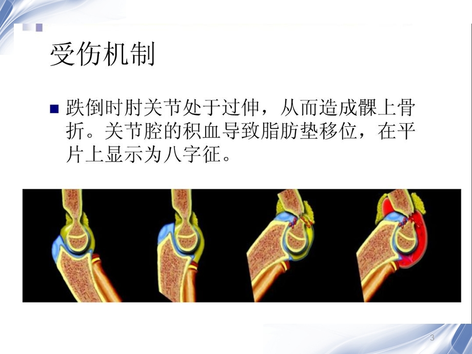 医学影像儿童肘关节骨折X线诊断.ppt_第3页