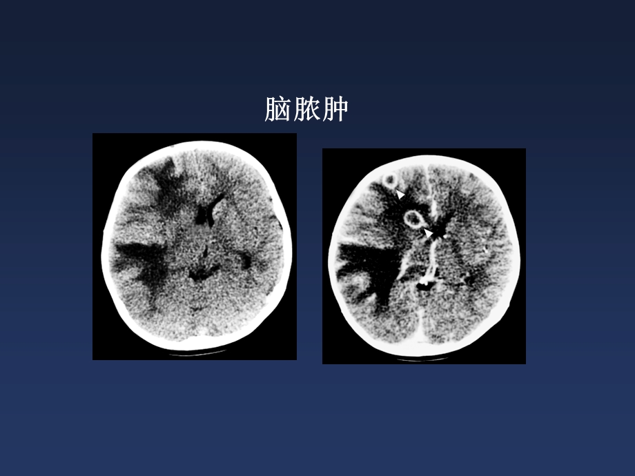 中枢神经系统5颅内感染性疾病.ppt_第3页