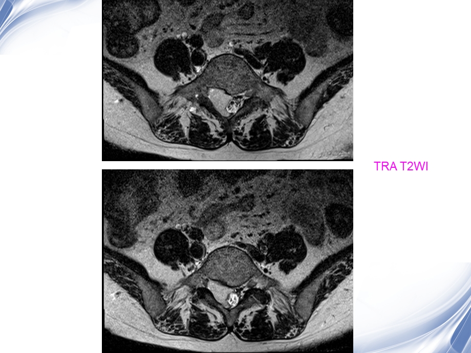 医学影像病例随访椎管病变影像诊断.ppt_第3页