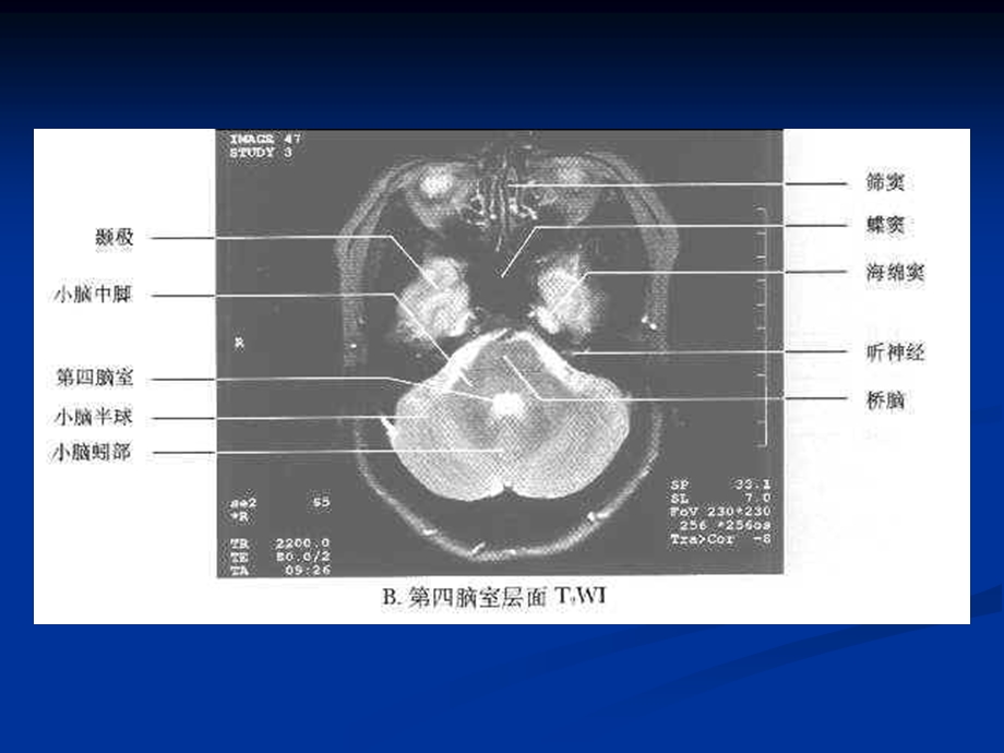 中枢神经系统常见肿瘤的MRI诊断安徽医科大学第一附属医院钱银锋.ppt_第3页