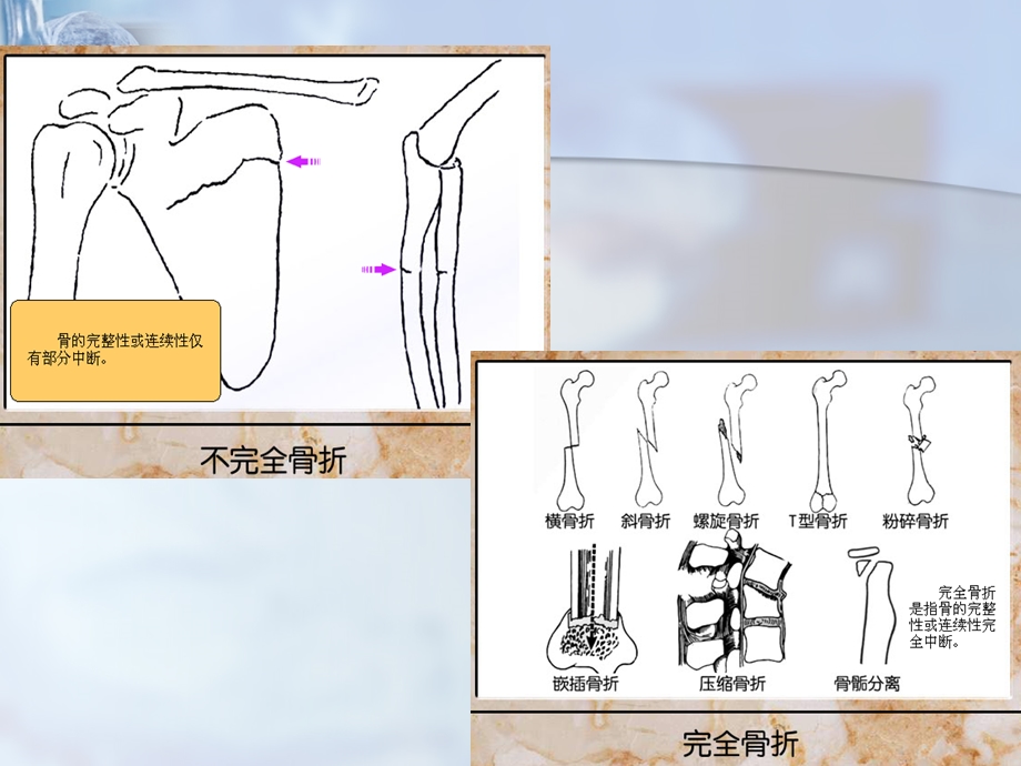 《创伤骨折急救》PPT课件.ppt_第3页