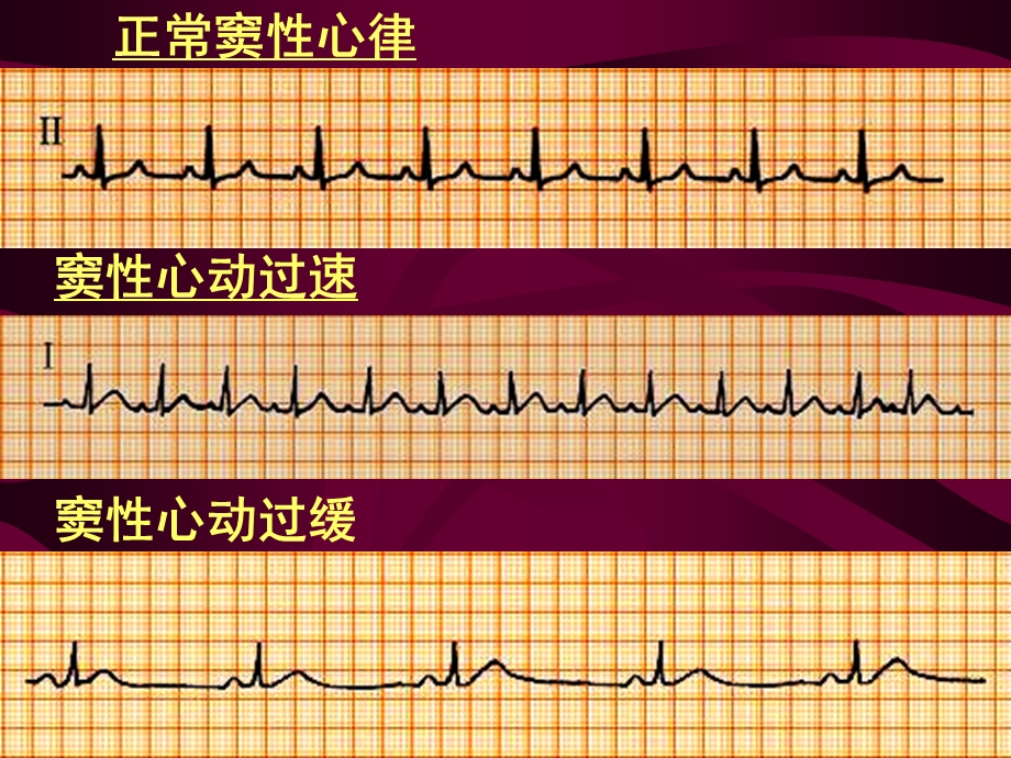 《心电图讲》PPT课件.ppt_第2页