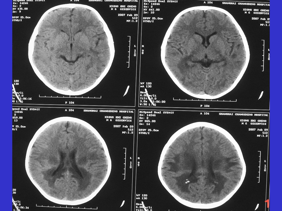 《常见脑白质病》PPT课件.ppt_第3页