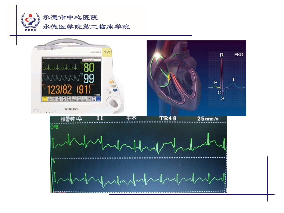 心电图监测、围术期心律失常.ppt_第3页
