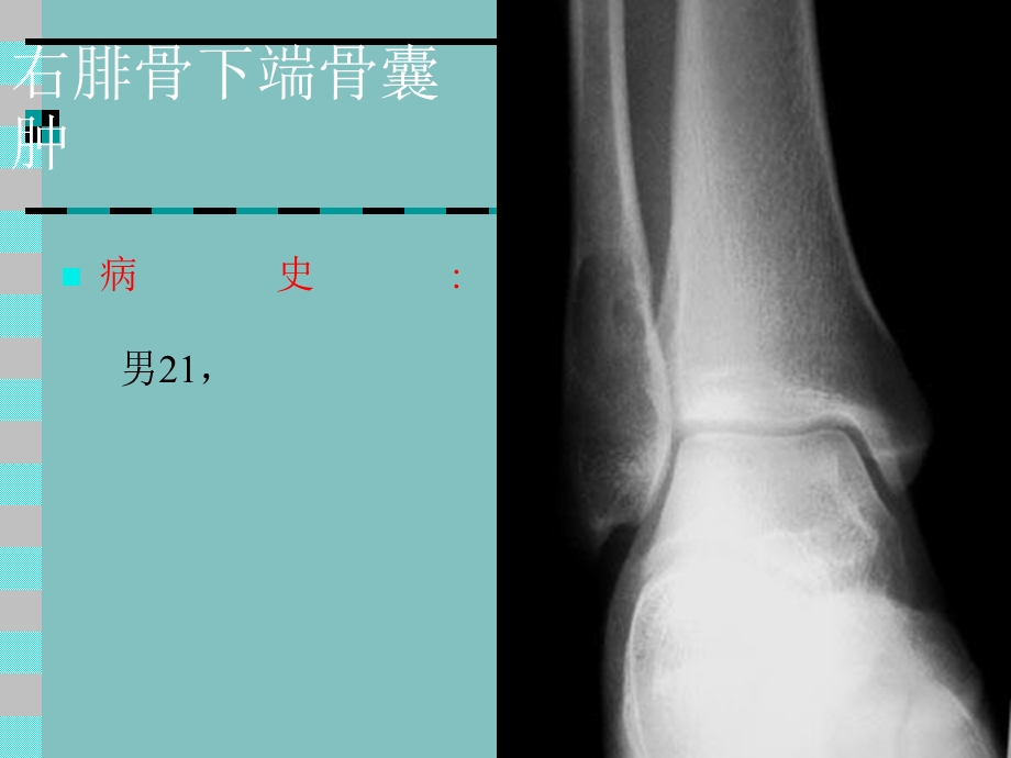 《右腓骨下端骨囊肿》PPT课件.ppt_第1页