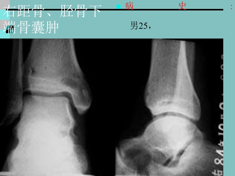 《右腓骨下端骨囊肿》PPT课件.ppt_第2页